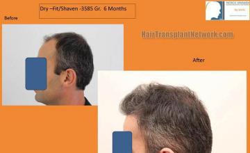 Hair restoration procedure before and after pictures