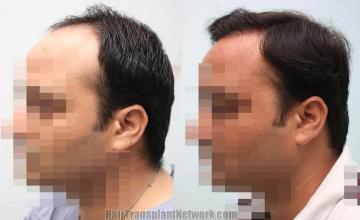 Hair transplantation surgery before and after pictures