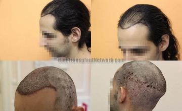 Hair transplantation surgery before and after photos