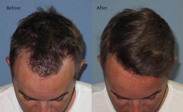 Hair restoration procedure before and after results