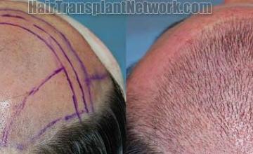 Before and immediate postoperative hair transplant