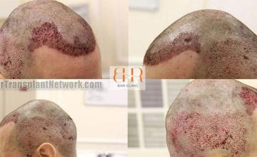 Surgical hair transplantation result photographs