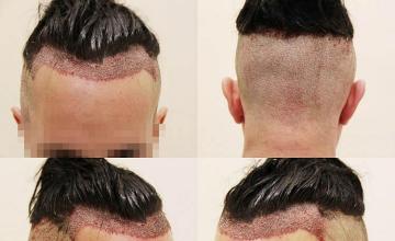 Surgical hair transplantation result photographs