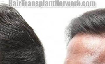 Hair restoration procedure before and after results