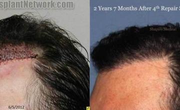 Hair transplantation surgery before and after pictures