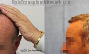 Hair transplantation surgery before and after images