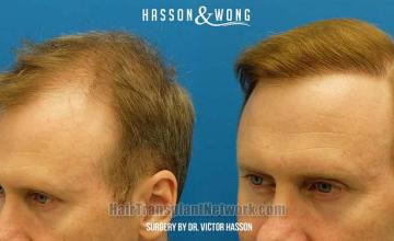 Hair transplantation surgery before and after images