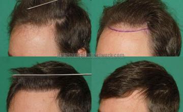 Hair transplantation surgery before and after pictures