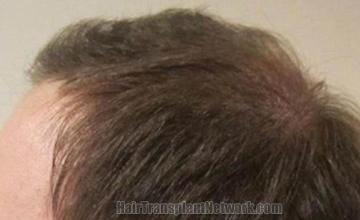 Hair transplantation surgery before and after pictures