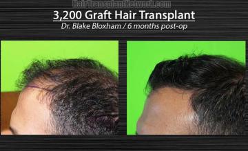 Hair restoration surgery before and after images