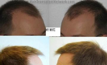 Hair transplantation surgery before and after photos