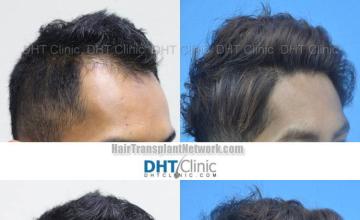 Hair transplantation procedure before and after results