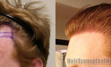 Hair transplantation surgery before and after images