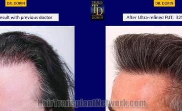 Hair transplantation surgery before and after images