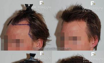 Hair transplantation surgery before and after pictures