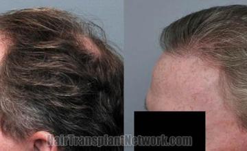 Hair transplantation surgery before and after images