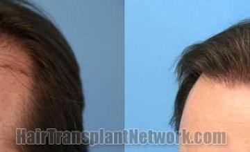 Hair transplantation surgery before and after images