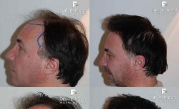 Photos of before and after hair transplant procedure