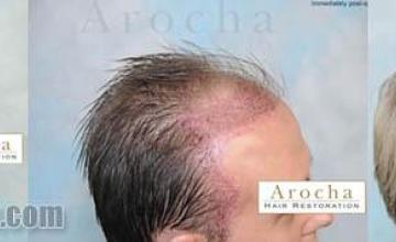 Hair restoration procedure before and after results