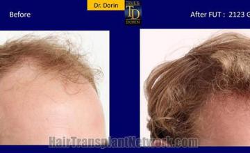 Hair transplantation surgery before and after pictures