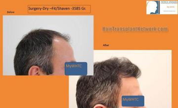 Hair transplantation surgery before and after images