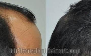 Hair transplantation surgery before and after images