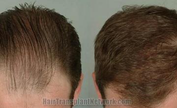 Hair transplantation surgery before and after pictures