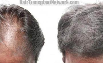 Top view - Before and after surgical hair replacement