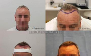 Hair restoration procedure before and after results