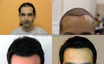 Hair restoration procedure before and after results