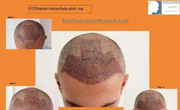 Hair restoration surgery before and after images