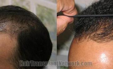 Before and after hair transplant surgical procedure