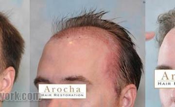 Hair transplantation surgery before and after photos