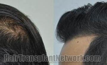 Hair transplantation surgery before and after pictures