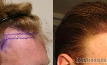 Hair transplantation surgery before and after photos