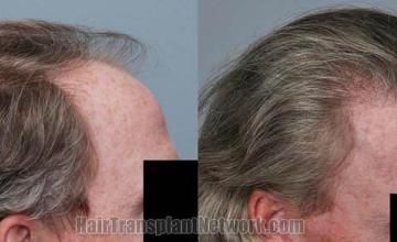 Hair transplantation surgery before and after photos