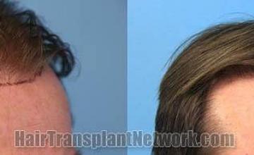 Hair transplantation surgery before and after photos