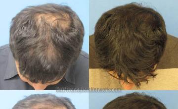 Before and after hair transplantation photos