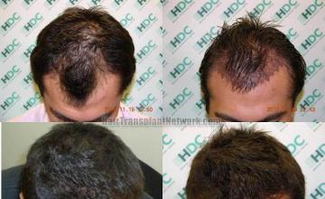 Top view before and after hair restoration results