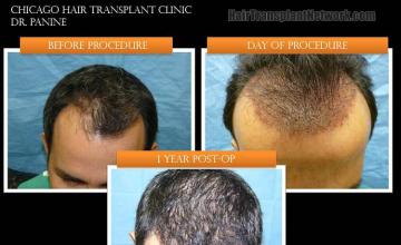 Top view before and after hair restoration results