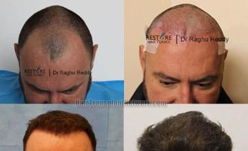 Hair restoration procedure before and after results