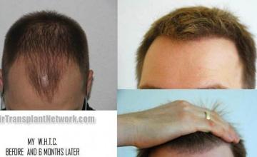 Hair restoration procedure before and after results