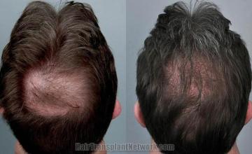 Hair transplantation surgery before and after pictures