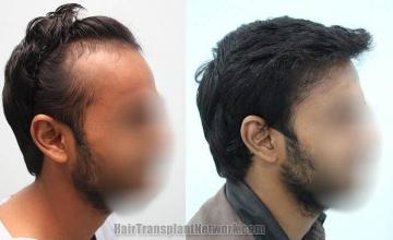 Hair transplantation surgery before and after images