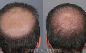 Hair transplantation surgery before and after pictures