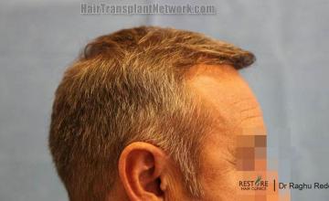 Hair transplantation surgery before and after photos