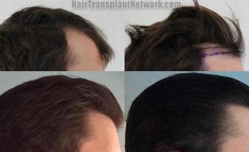 Hair transplantation surgery before and after images