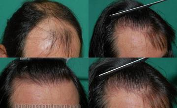 Hair transplantation surgery before and after photos