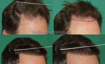 Hair transplantation surgery before and after images