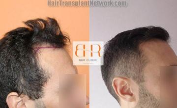 before and after photos